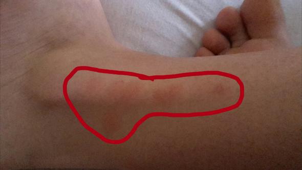 Stiche An Den Fussen Nach Schlafen Fusse Bett Juckreiz