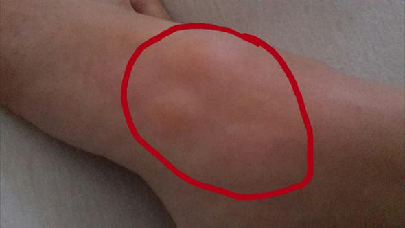 Stiche An Den Fussen Nach Schlafen Fusse Bett Juckreiz