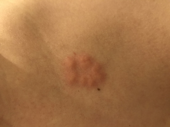 Stiche In Kreisform Haut Insekten Allergie Stiche In Kreisform Haut Insekten Allergie