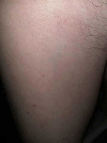 Stiche Ist Es Ein Floh Gesundheit Und Medizin Ausschlag Stich Stiche Ist Es Ein Floh Gesundheit Und Medizin Ausschlag Stich