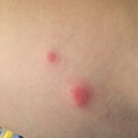 Stiche Nach Dem Schlafen Parasiten Wanzen Stiche Nach Dem Schlafen Parasiten Wanzen