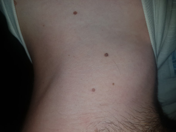 Stielwarzen Kann Man Sie Selber Entfernen Gesundheit Und Medizin Entfernung Stielwarzen Kann Man Sie Selber Entfernen Gesundheit Und Medizin Entfernung