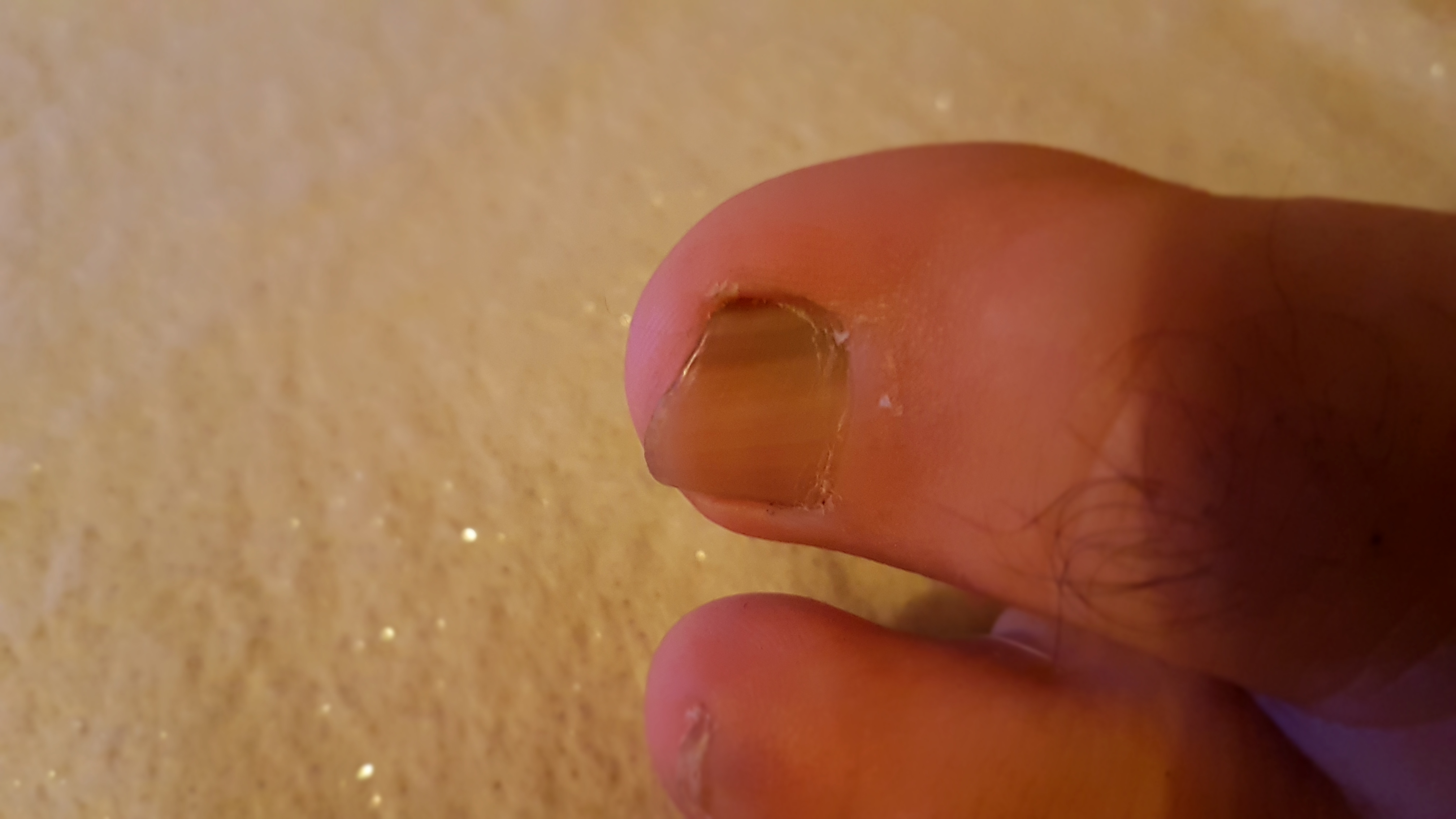 Schwarzer Hautkrebs Zehennagel Bilder Nageldesign Bilder