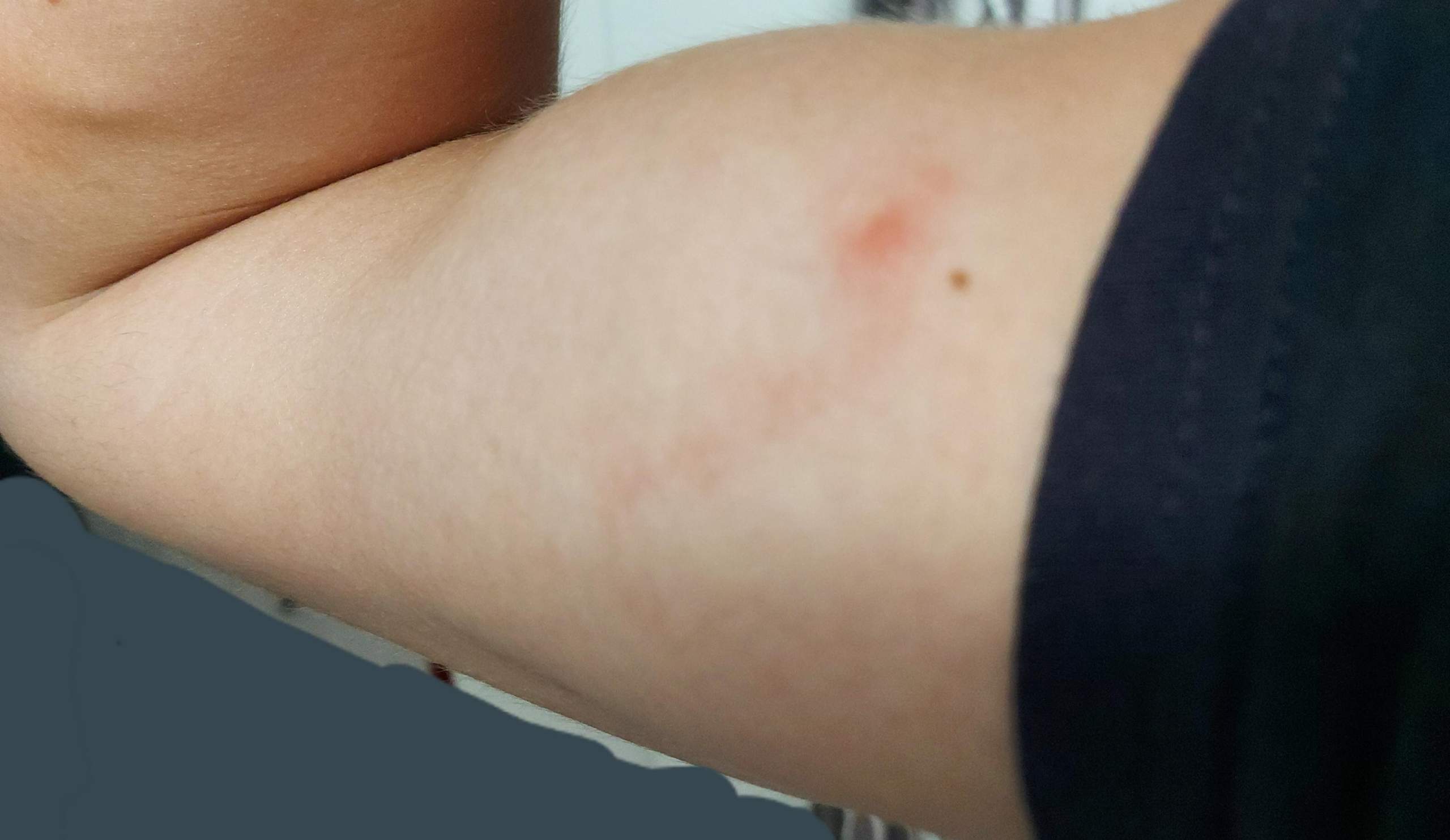 Streifen auf der Haut nach Zeckenbiss? (Gesundheit und Medizin