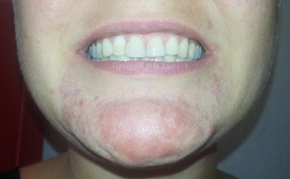 Stress Hautausschalg Mit Starken Abschuppungen Im Gesicht Rosazea Periorale Dermatitis Angst Haut Hautausschlag