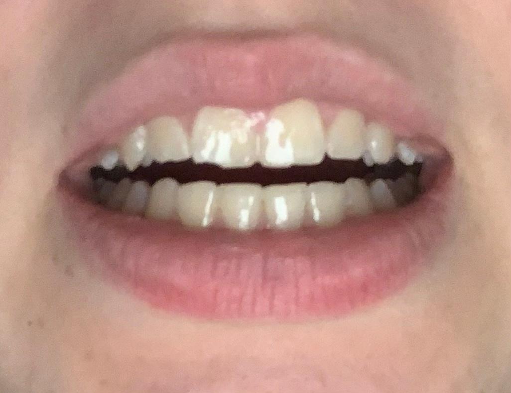 Stuck Zahn Abgebrochen Fallt Das Sehr Auf Gesundheit Und Medizin Gesundheit Umfrage Stuck Zahn Abgebrochen Fallt Das Sehr Auf Gesundheit Und Medizin Gesundheit Umfrage