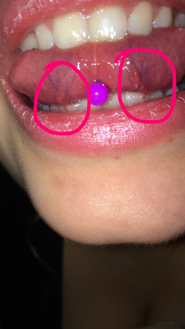 Stuckchen Von Zunge Geht Ab Normal Wunde Stuckchen Von Zunge Geht Ab Normal Wunde