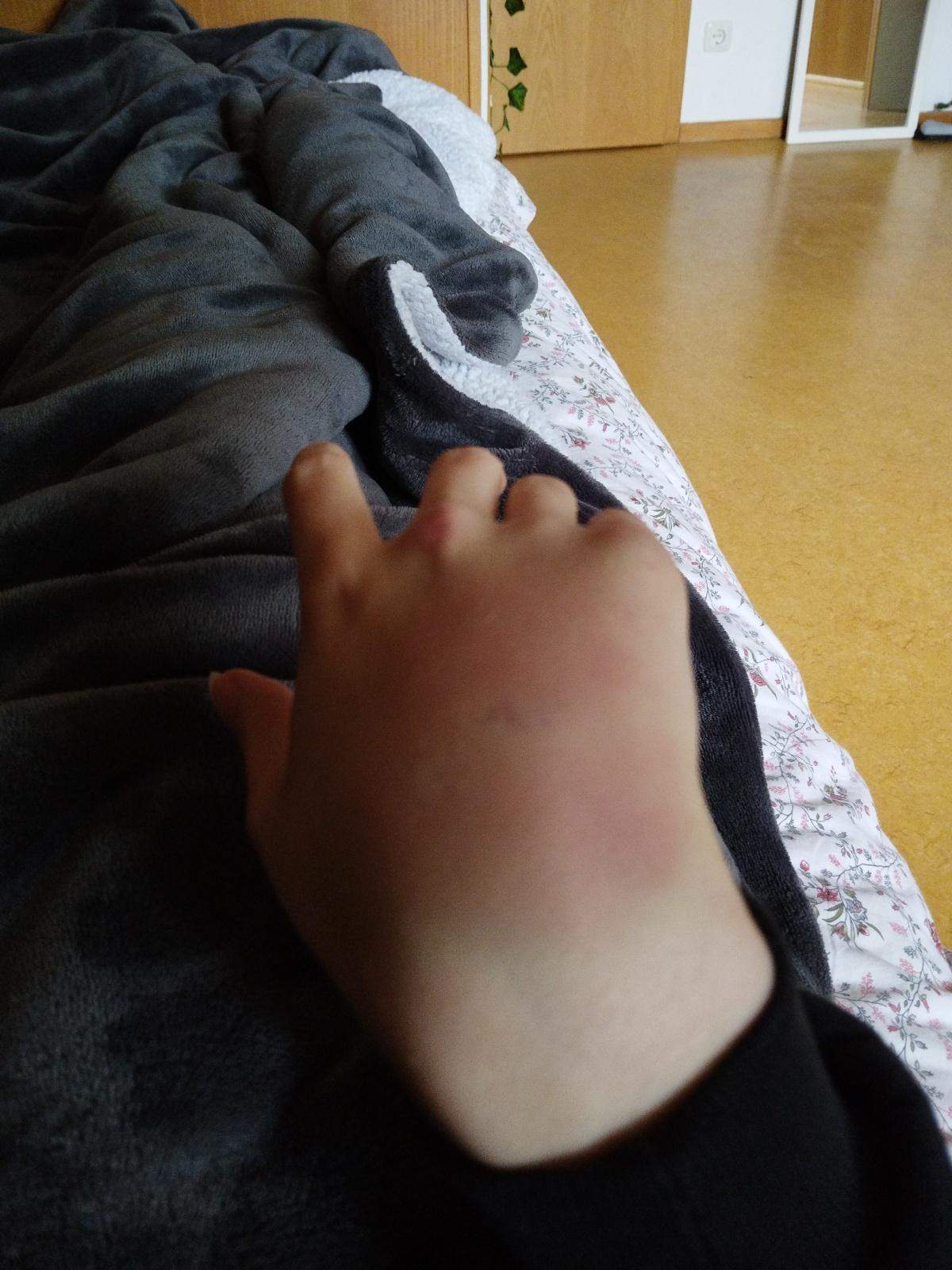 Sturz Auf Handballen
