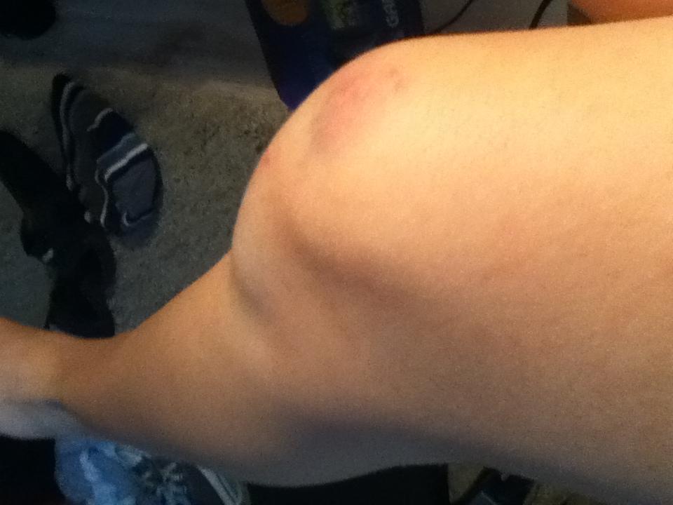 Sturz Auf Knie Arzt Sturz Auf Knie Arzt