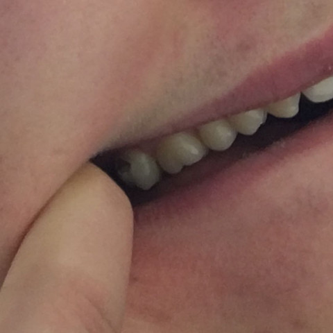 Zahn ganz links  - (Gesundheit und Medizin, Zähne, Zahnarzt)