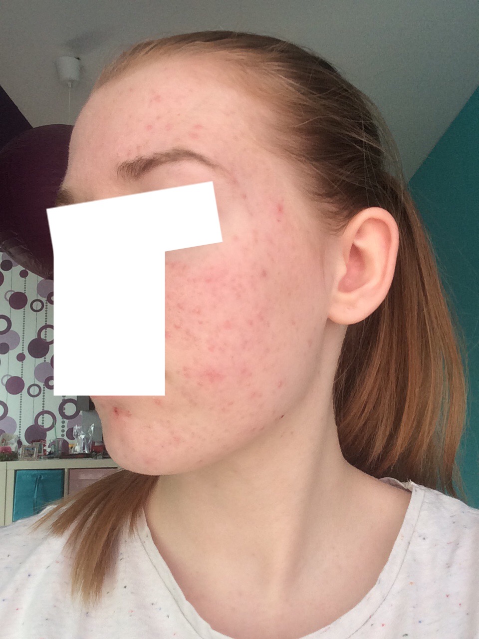 Tabletten gegen leichte Akne? (Pickel, kapseln)