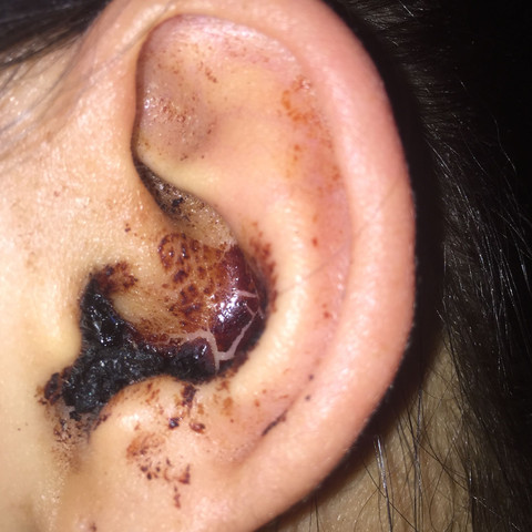 So sieht mein Ohr grad aus  - (Gesundheit und Medizin, Operation, Ohr)