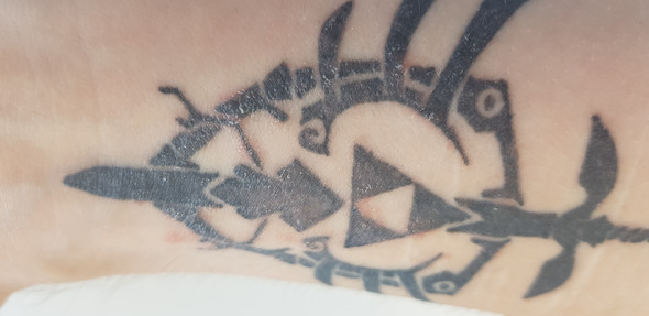 - (Tattoo, Allergie, Entzündung)