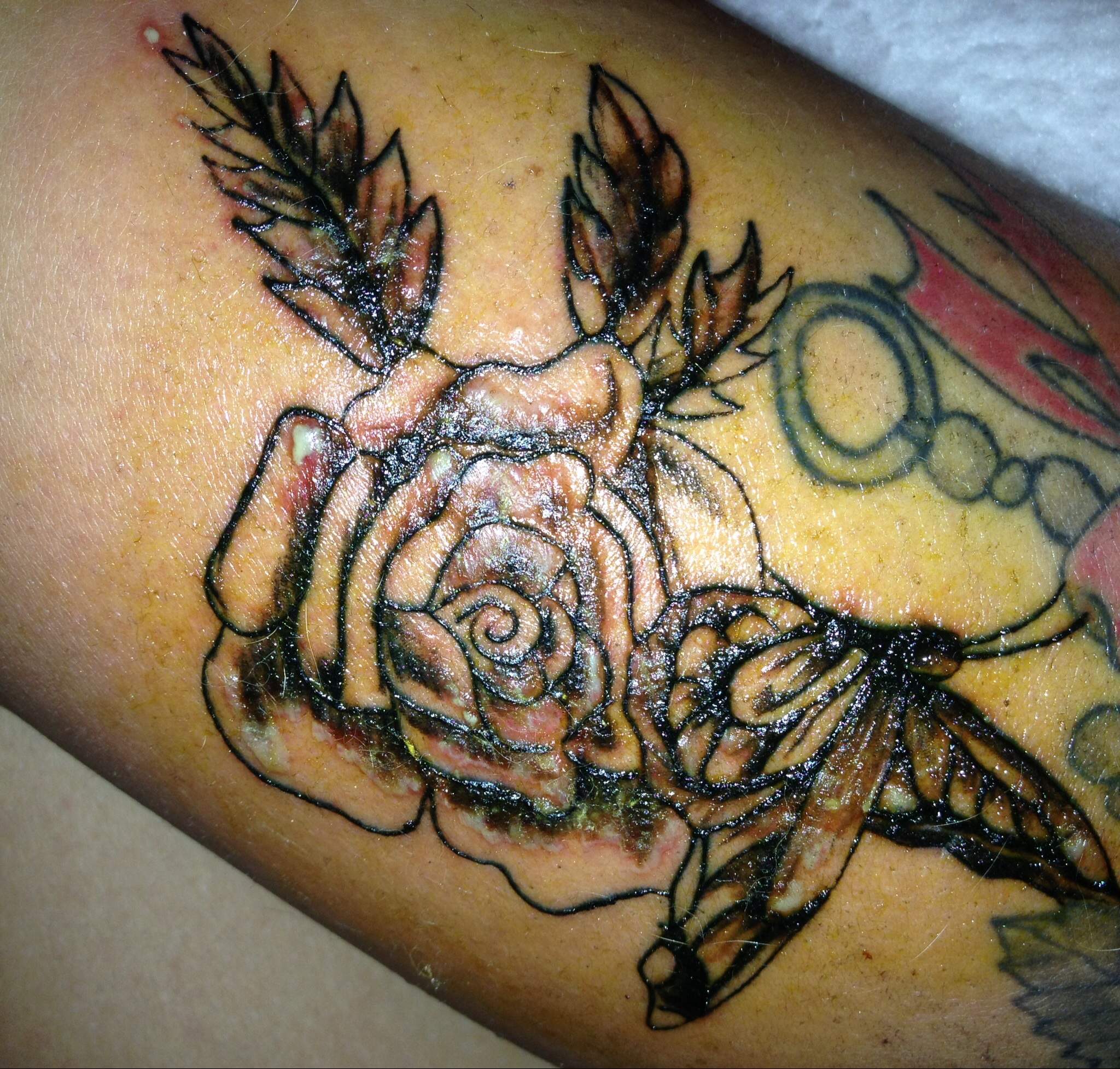 Tattoo entzündet 5& (Entzündung)