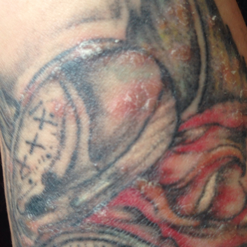 Tattoo entzündet ja oder nein? Wer kann mir helfen wie bekomm ich es ...