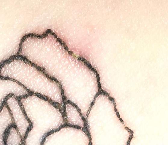 Tattoo Normal Oder Entzundet Gesundheit Und Medizin Entzundung Neu Tattoo Normal Oder Entzundet Gesundheit Und Medizin Entzundung Neu