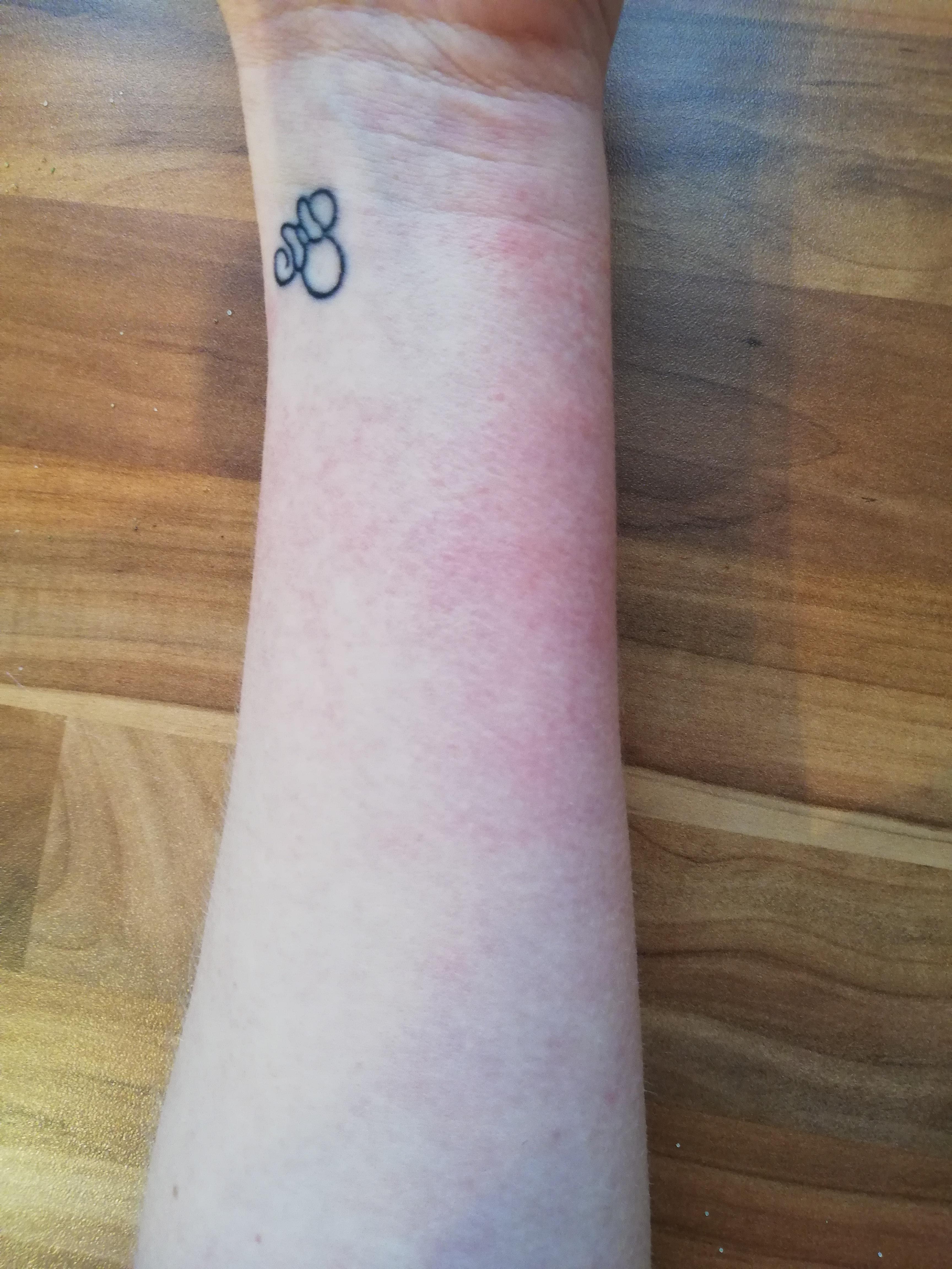 Allergische Reaktion Auf Tattoo Captions Save