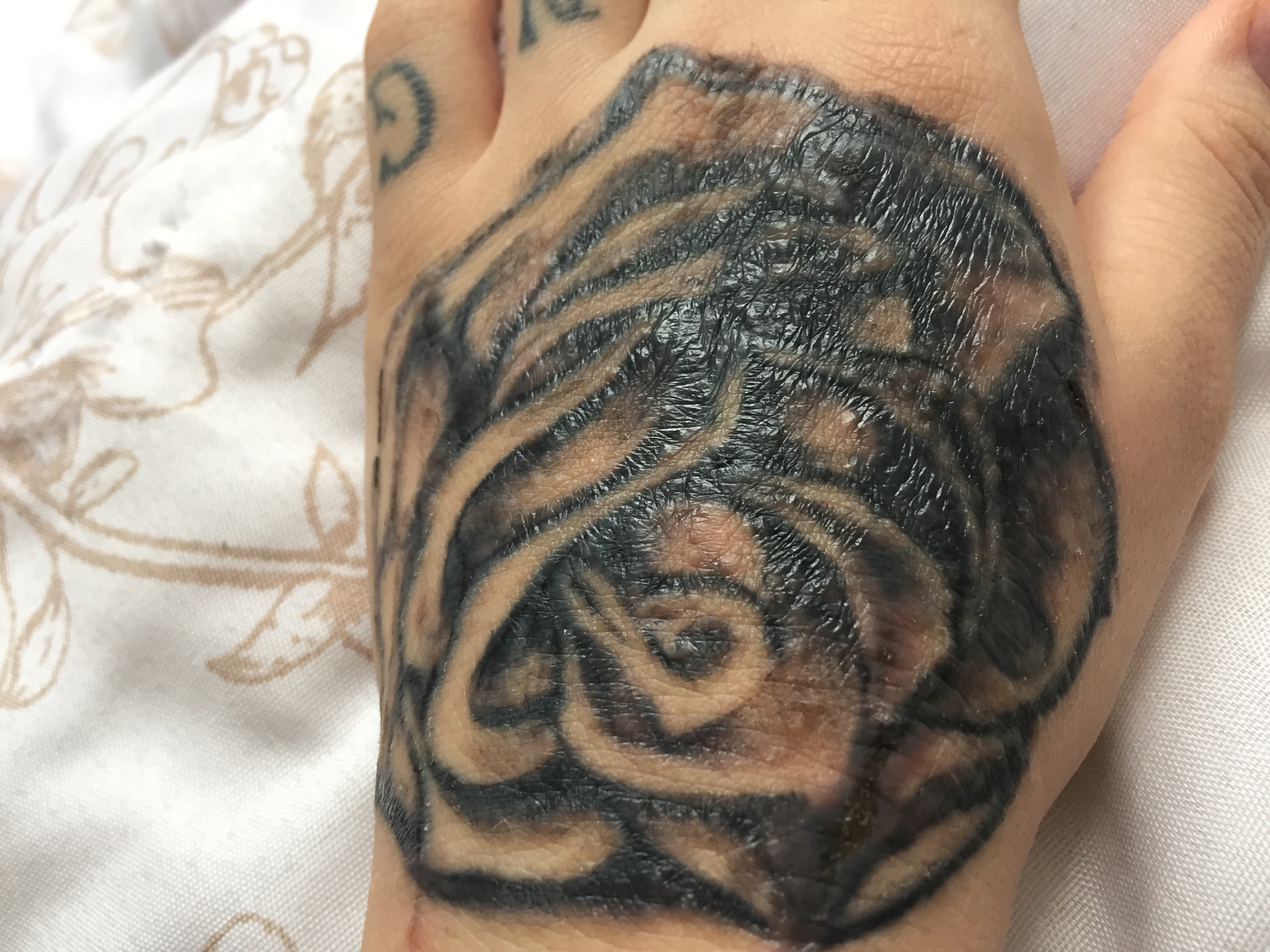 Tattoo sieht vernarbt aus , wird meine Haut wieder normal ? (Narben)