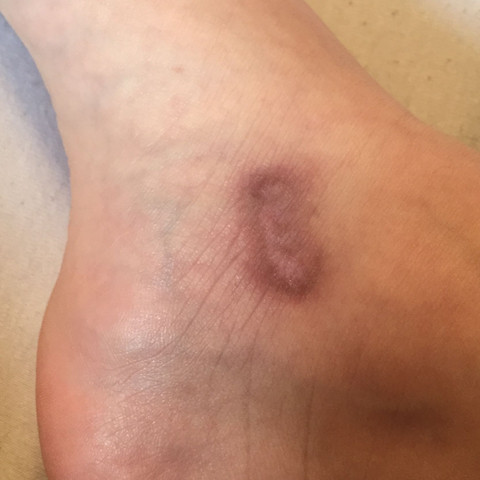 Tattoo Uber Narbe Geht Das Narben Tatowieren Tatowierung