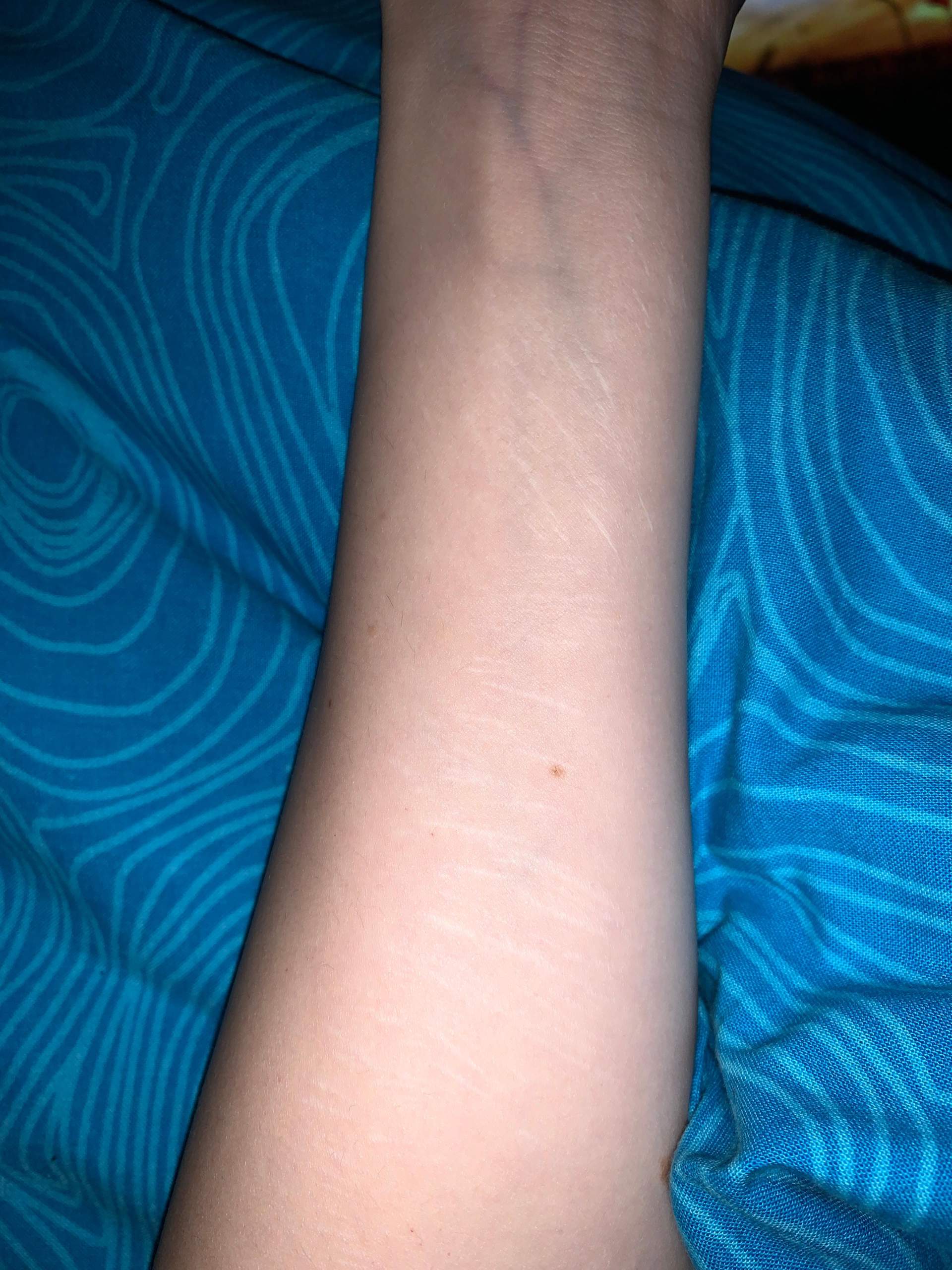 Tattoo über Narben?