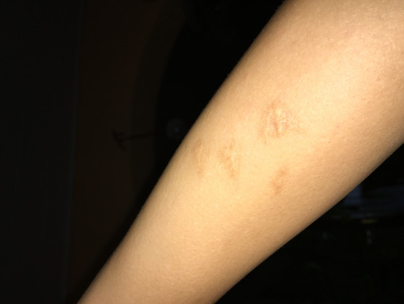 Tattoo Uber Narben Geht Das Tatowieren Tatowierung