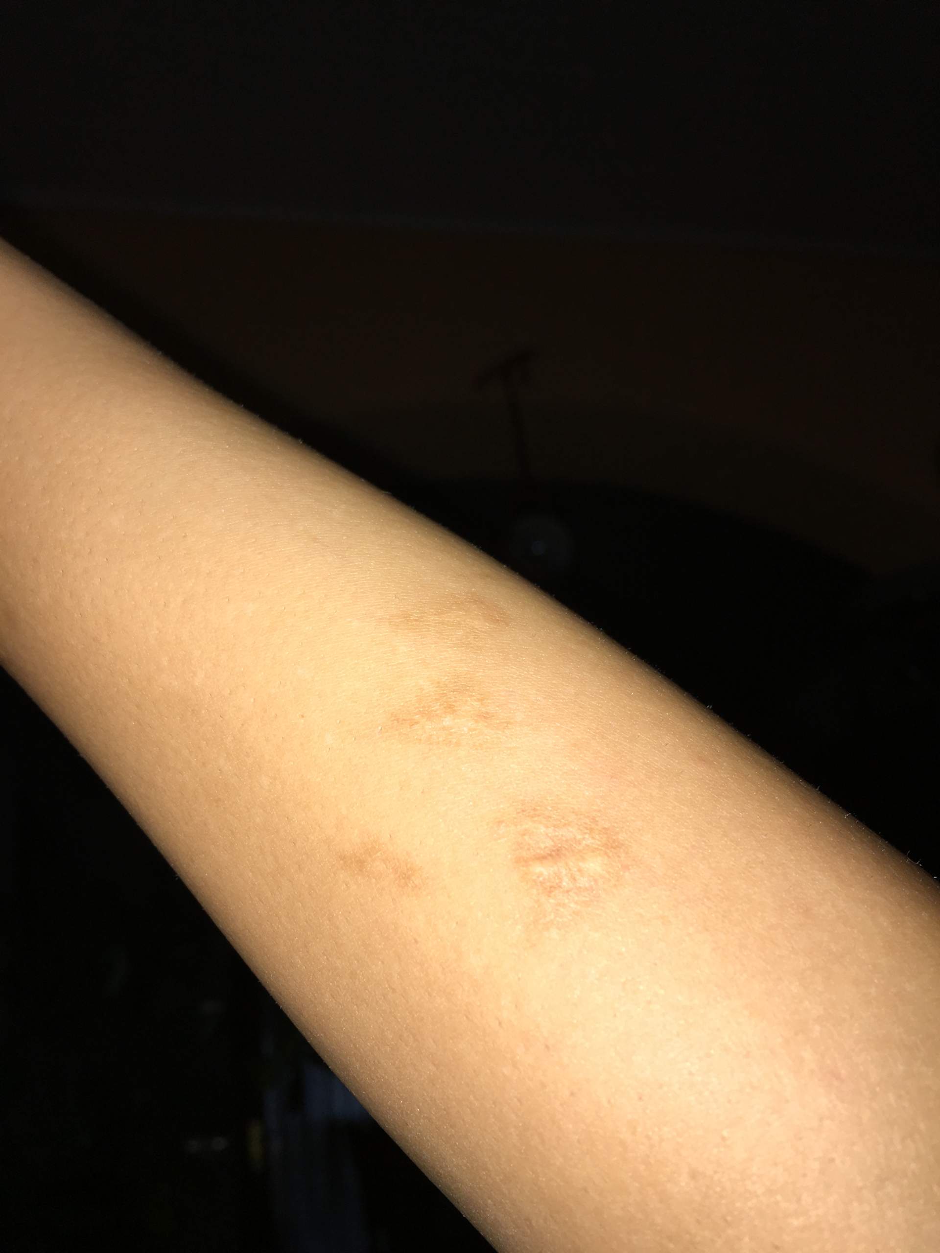 Tattoo über Narben, geht das? (tätowieren)