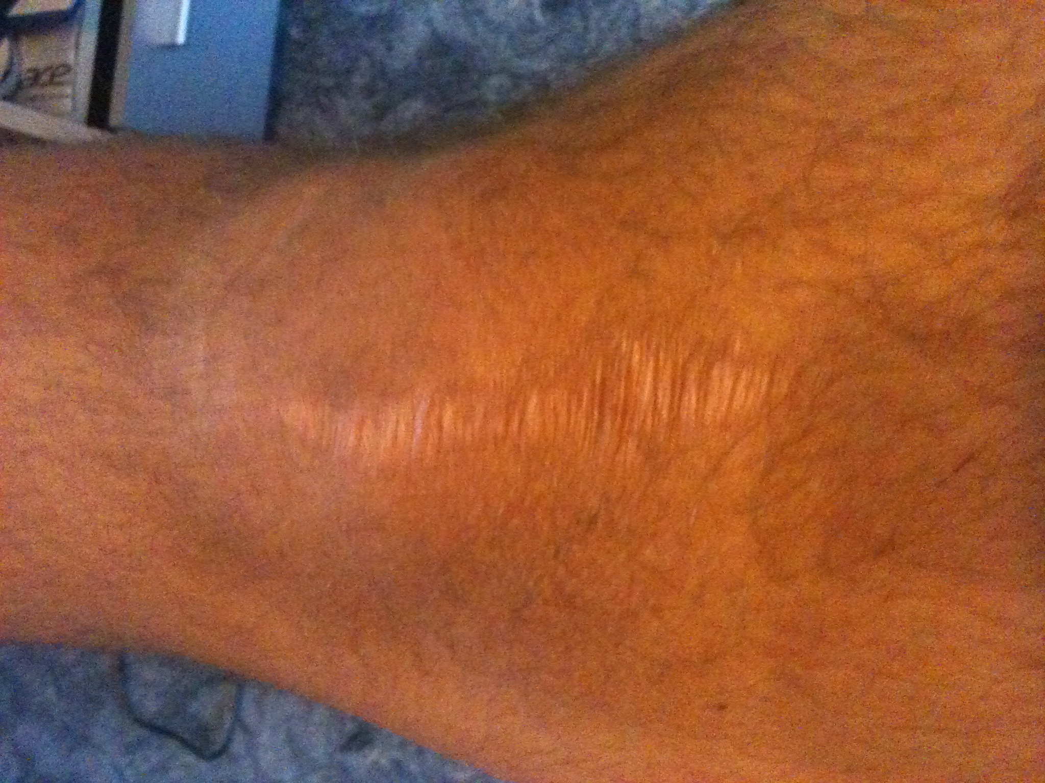 Tattoo um/über narbe + Ideen (Narben)
