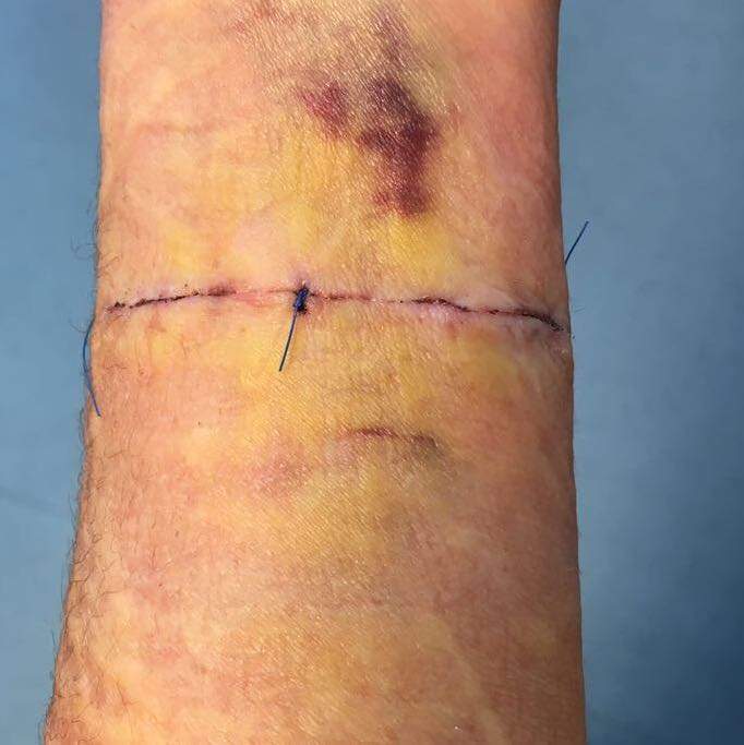 Tattooentfernung Narbenbildung!? (Medizin, Körper, Biologie)