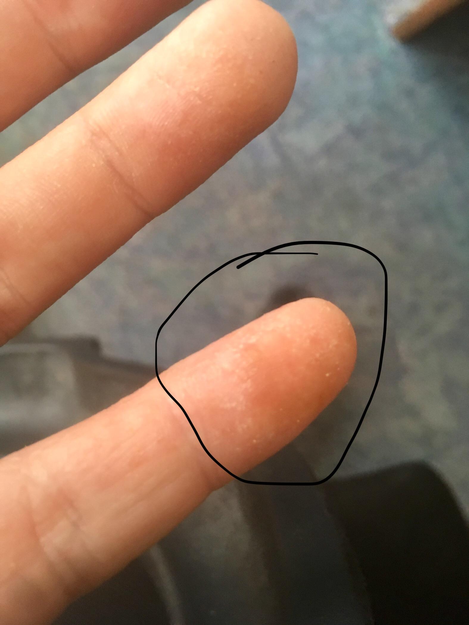 Taube Fingerspitze Gesundheit Und Medizin Haut Taube Fingerspitze Gesundheit Und Medizin Haut