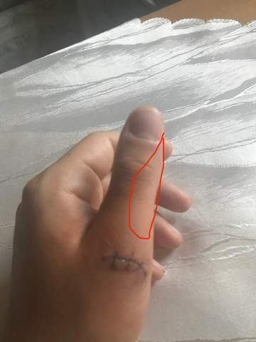 Taubheitsgefuhl Im Finger Nach Nahung Gesundheit Und Medizin Gesundheit Medizin Taubheitsgefuhl Im Finger Nach Nahung Gesundheit Und Medizin Gesundheit Medizin