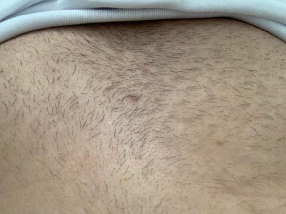 testesteronmangel und erektionstorung