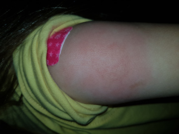 Tetanusauffrischung Mit 5 Jahren Arm Hart Rot Geschwollen Oder Eine Entzundung Gesundheit Und Medizin Auffrischung Tetanusauffrischung Mit 5 Jahren Arm Hart Rot Geschwollen Oder Eine Entzundung Gesundheit Und Medizin Auffrischung