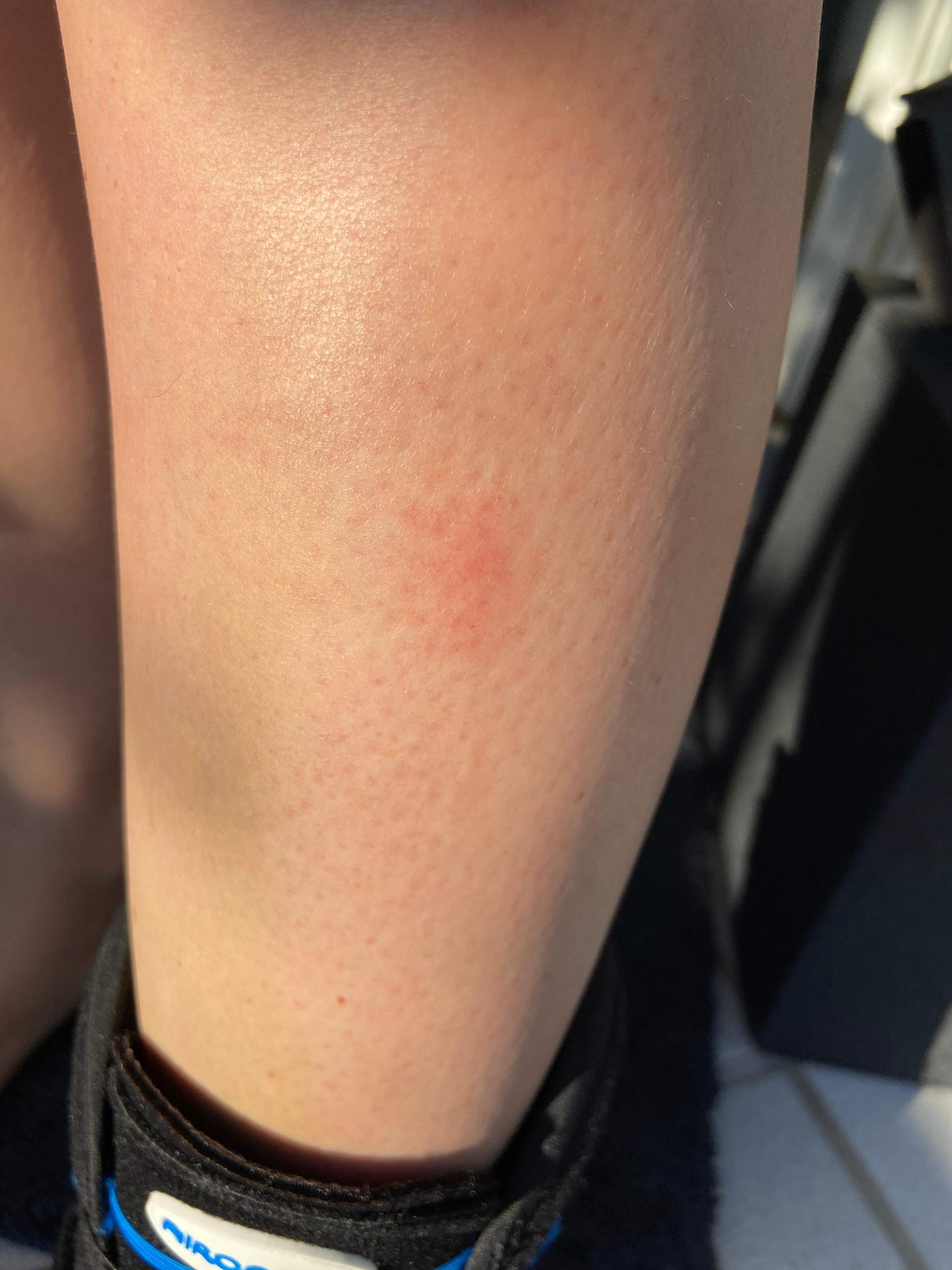 Blaue Flecken Am Bein Thrombose