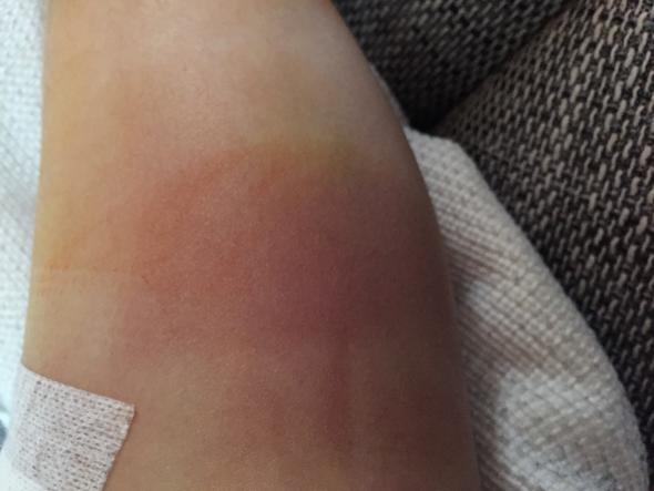 Thrombose? An Wade nach OP? (Operation)