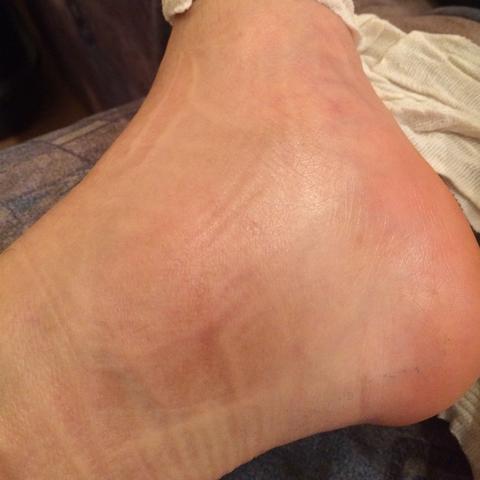 Thrombose Angst Gesundheit Medizin Arzt Thrombose Angst Gesundheit Medizin Arzt