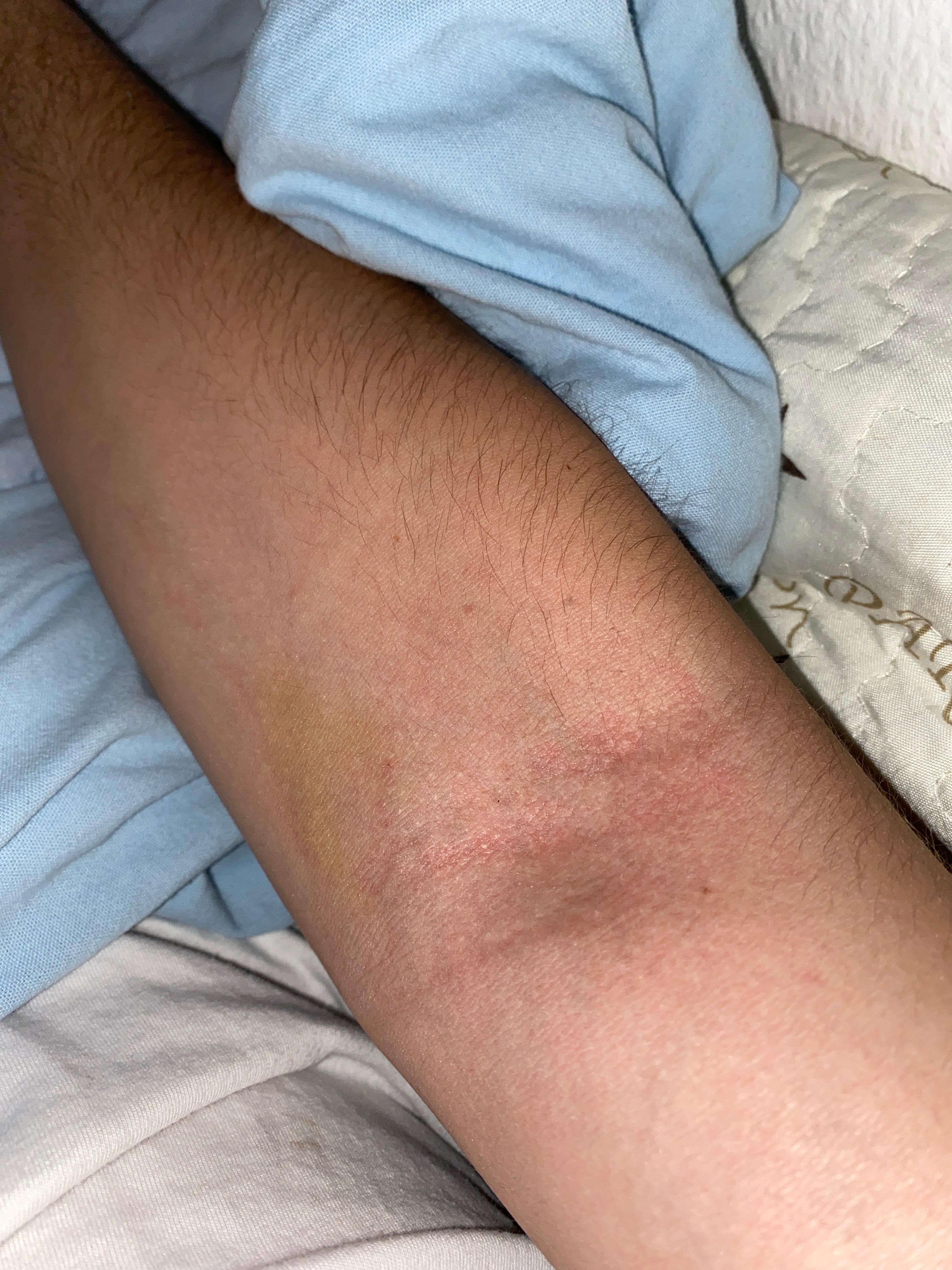 39++ Thrombose im arm bilder , Trombose Im Arm / Thrombose Wikipedia / Eine thrombose im arm ist