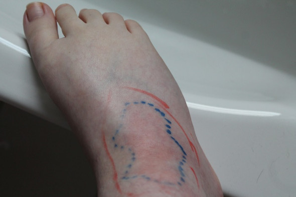 Thrombose im Fuß? (Gesundheit, Gesundheit und Medizin, Medizin) Thrombose im Fuß? (Gesundheit, Gesundheit und Medizin, Medizin)