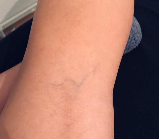Thrombose Kann Mir Jemand Helfen Gesundheit Und Medizin Thrombose Kann Mir Jemand Helfen Gesundheit Und Medizin