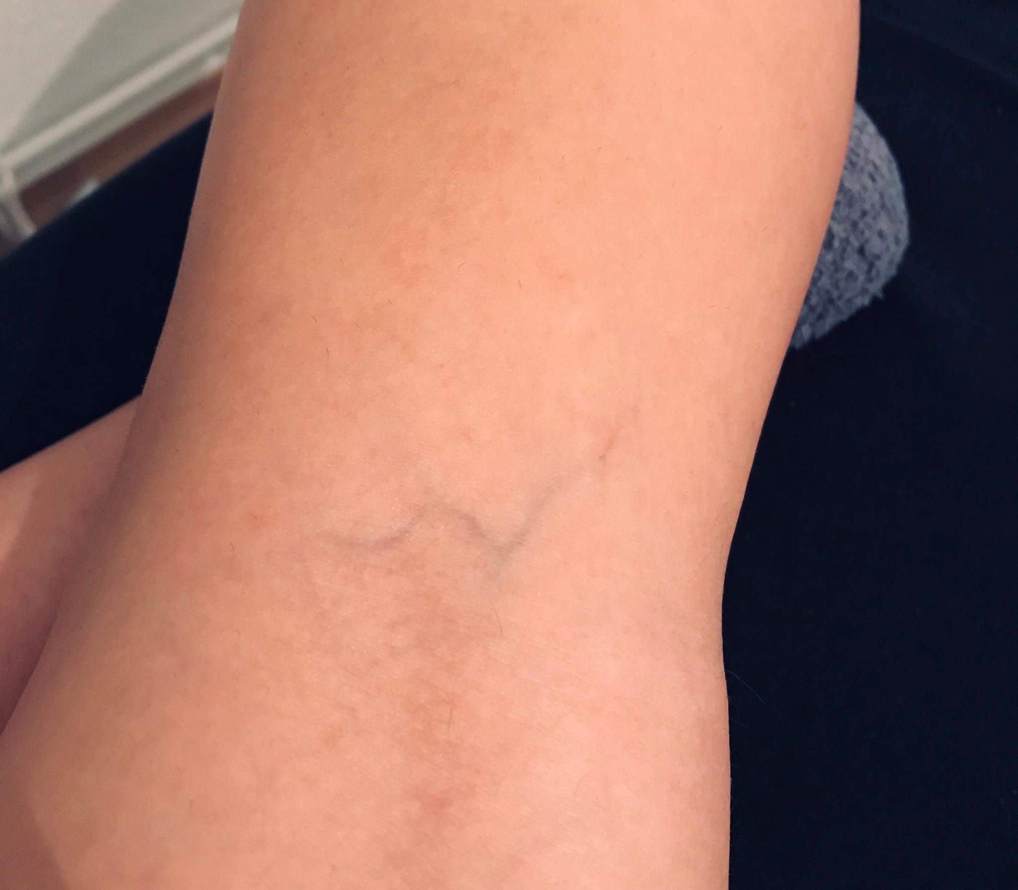 Thrombose Kann Mir Jemand Helfen Gesundheit Und Medizin Thrombose Kann Mir Jemand Helfen Gesundheit Und Medizin