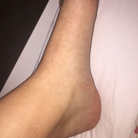 Thrombose Konnte Es Sein Gesundheit Pille Krank Thrombose Konnte Es Sein Gesundheit Pille Krank