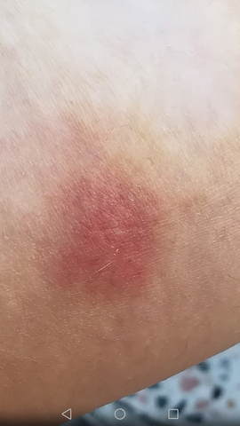 angst vor thrombose