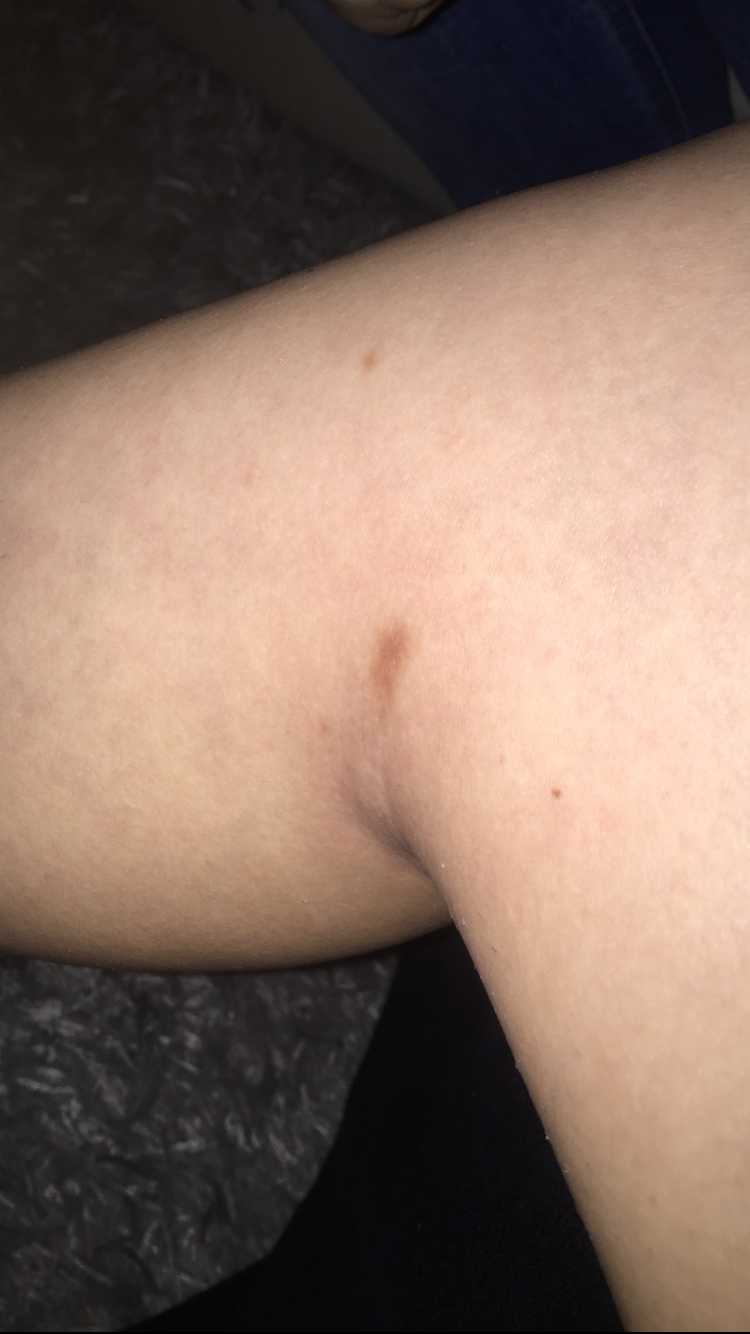 Thrombose Oder Was Anderes Gesundheit Und Medizin Gesundheit Medizin Thrombose Oder Was Anderes Gesundheit Und Medizin Gesundheit Medizin