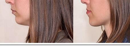 Tiefbiss Uberbiss Behandeln Gesundheit Zahnspange