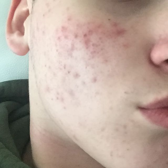 Tiefe Alte Narben Im Gesicht Entfernen Medizin Haut Pickel Tiefe Alte Narben Im Gesicht Entfernen Medizin Haut Pickel