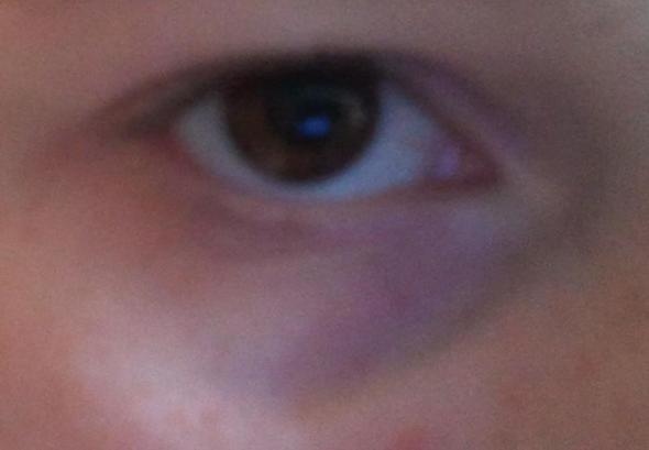 Das ist im gegensatz zu meinen Augenringen harmlos .!! ;) - (Operation, Creme, Augenringe)