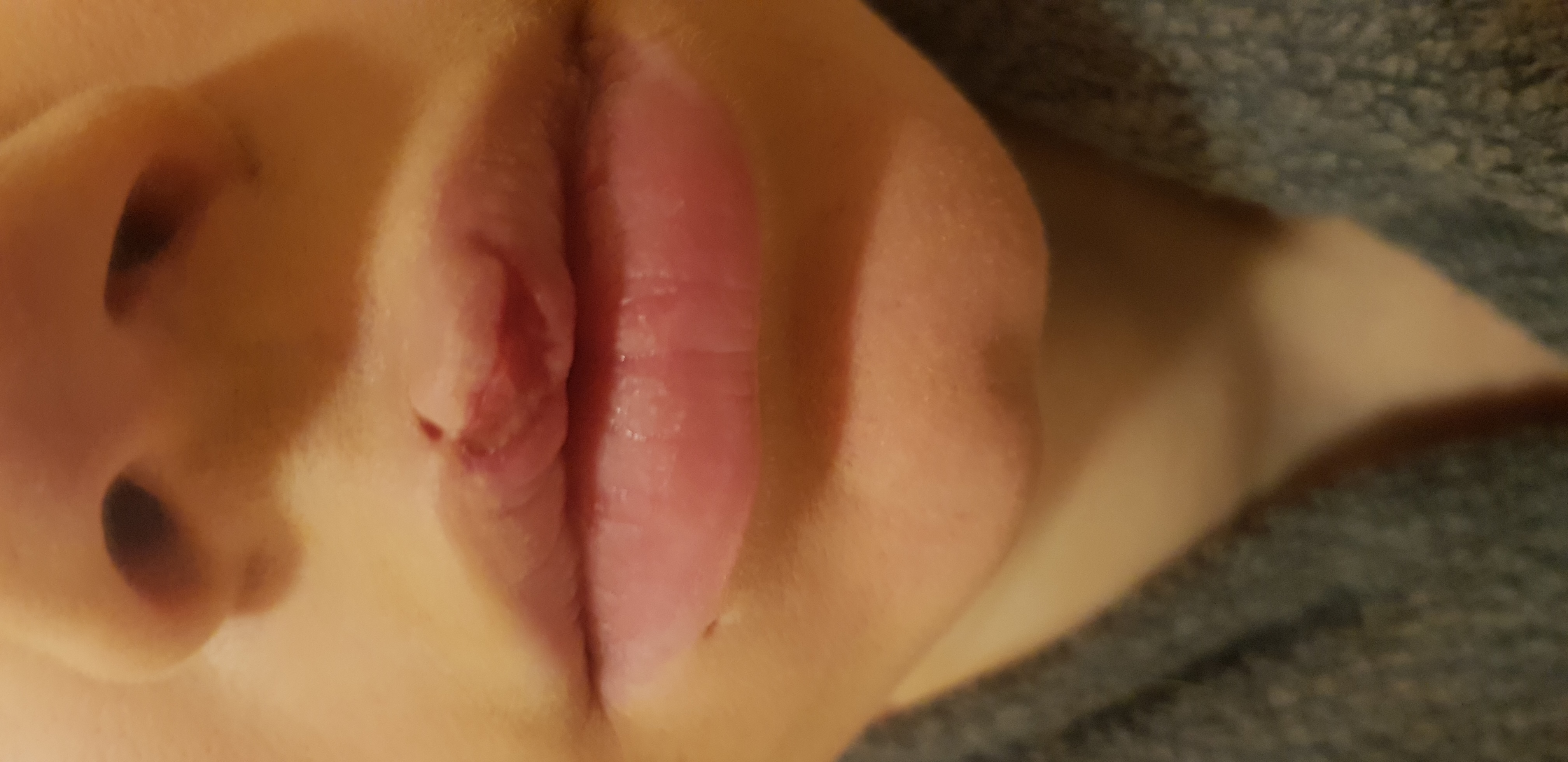 Tiefe Sekundarwunde Lippe Heilungschance Vertiefung