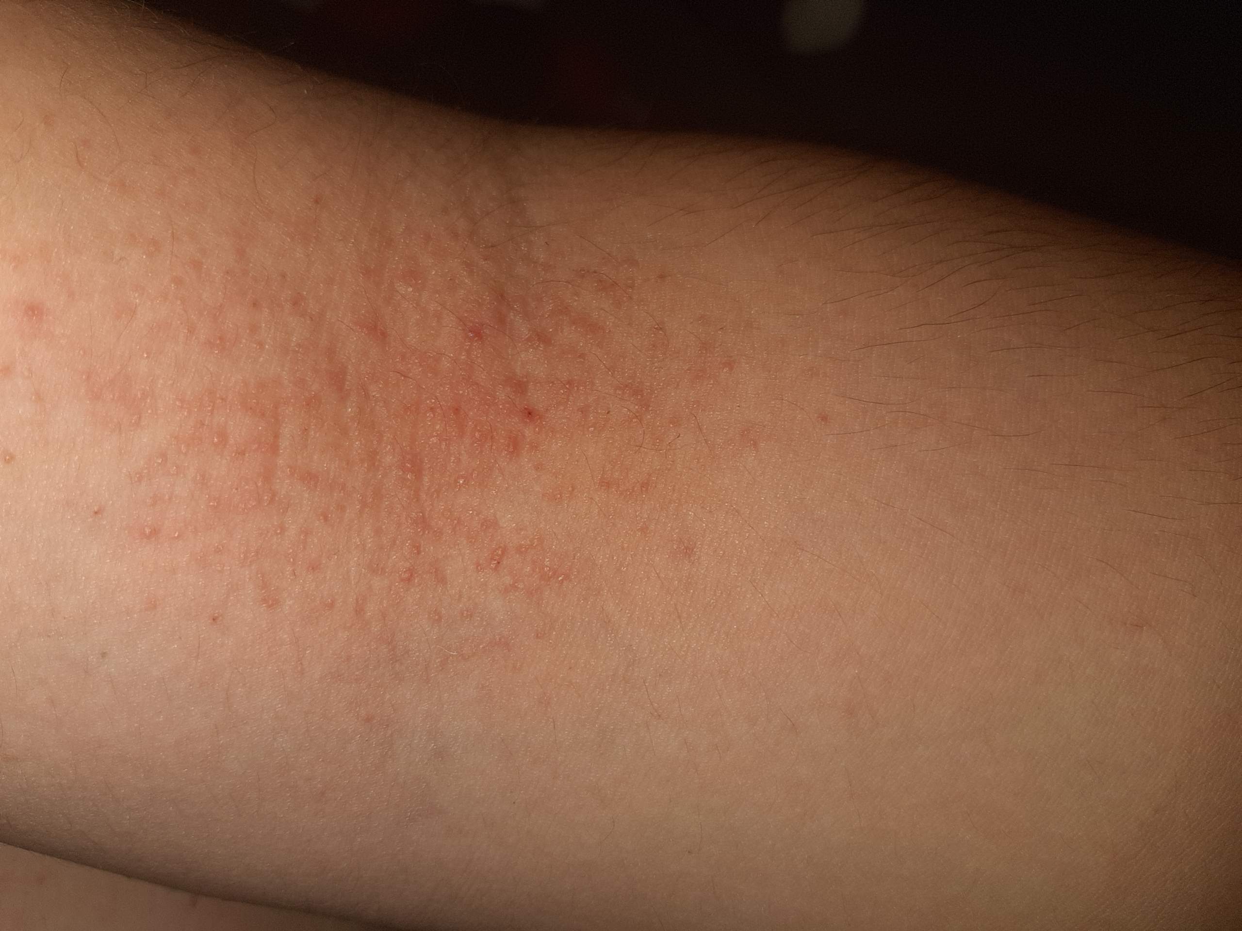 Tipp, was für ein Ausschlag ist das? (Gesundheit und Medizin, Medizin, Haut)