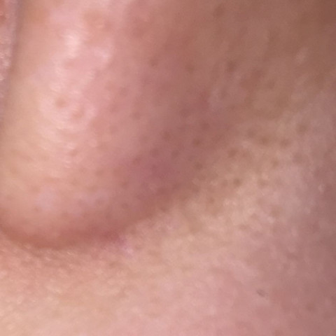 Bilder meiner Nase  - (Gesundheit und Medizin, Beauty, Haut)