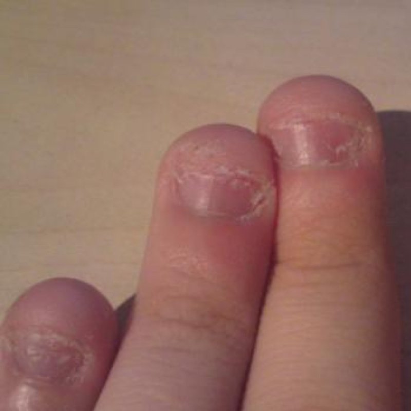 Tipps gegen nagelkauen (Freundin, Nägel, aufhören)
