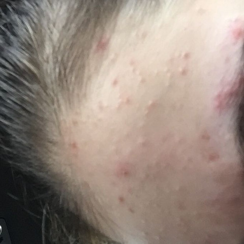 TIPPS GEGEN PICKEL BZW UNREINHEITEN? (Pubertät, Pflege, Gesicht) pickel in der pubertät